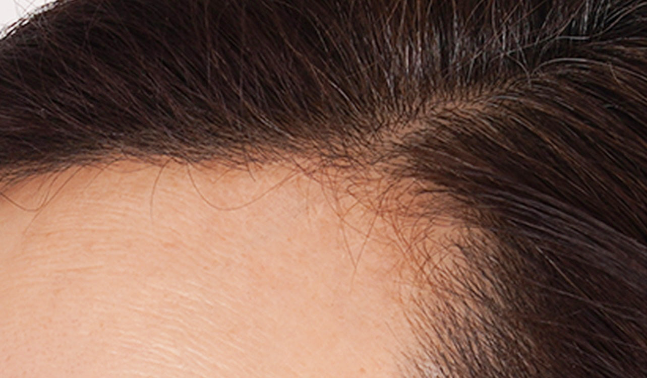 Close-up of a person's scalp with hairline