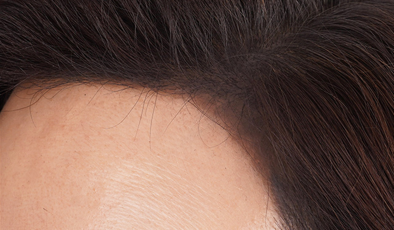 Close-up of a person's scalp with dark hair